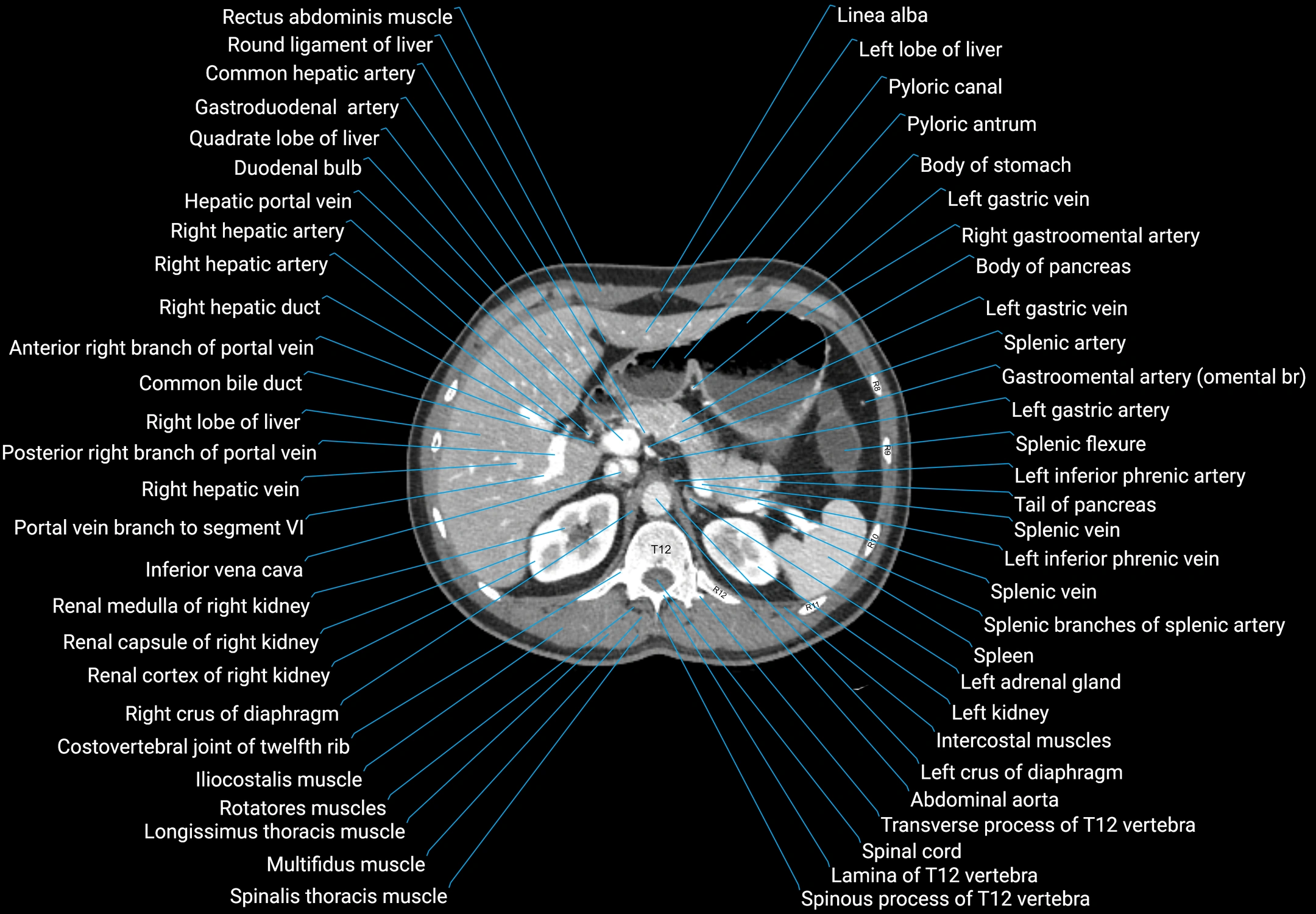 CT male pelvis axial cross sectional anatomy labelled radiology image -00044.webp